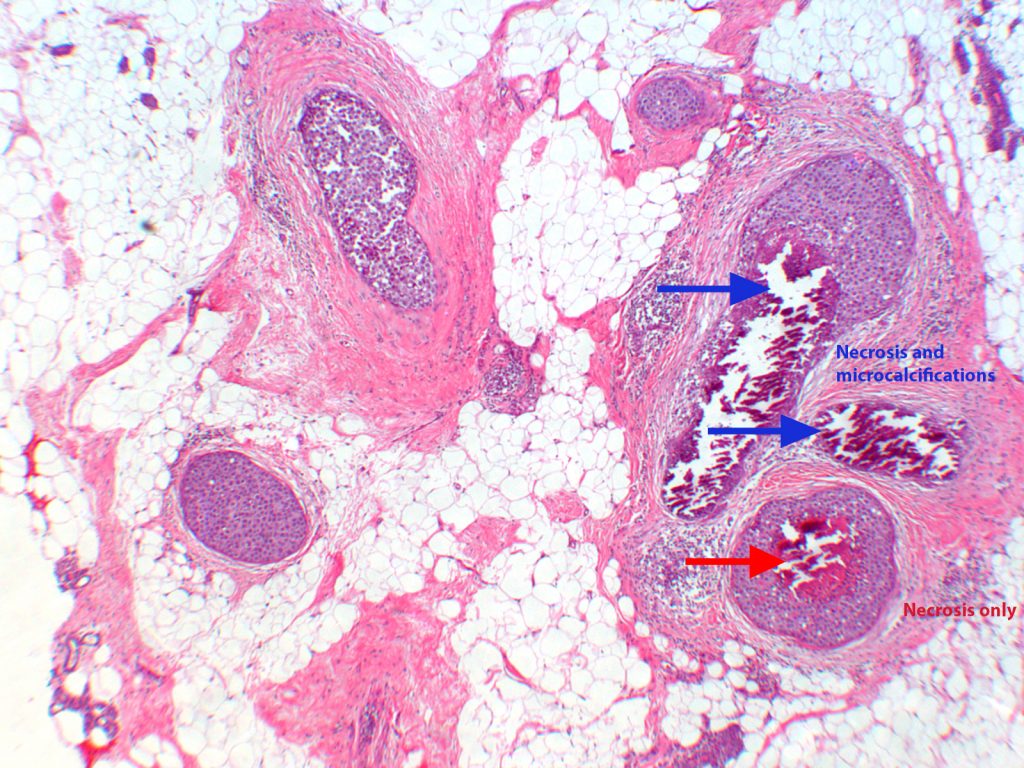 Ductal Carcinoma with text