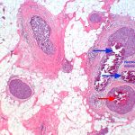 Ductal Carcinoma with text